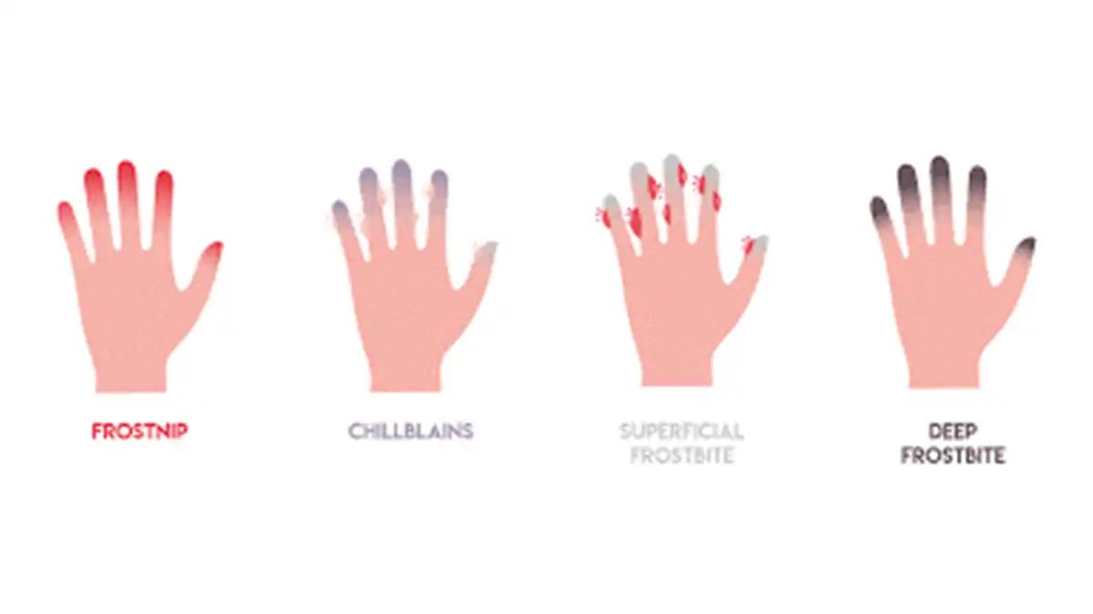 فرق سرمازدگی و هایپوترمی چیست؟