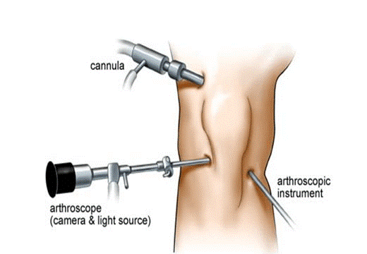 عمل آرتروسکوپی چگونه است