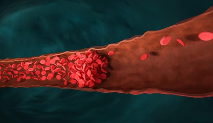 بازگشت DVT _ بازگشت دی وی تی