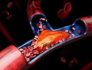 DVT and Similar disease