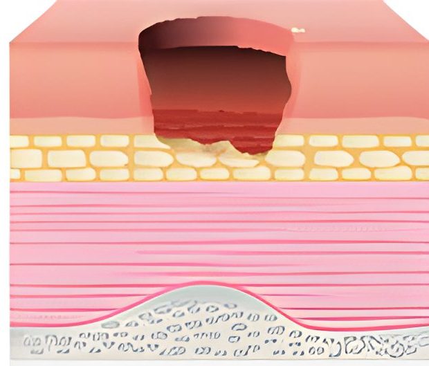 مرحله سوم زخم های فشاری