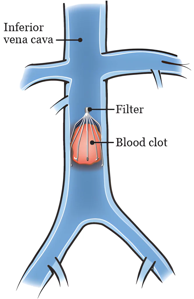 IVC درمان DVT