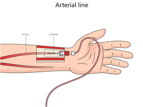 Artrial lineچیست