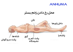 زخم بستر در چه قسمت هایی از بدن رخ می دهند