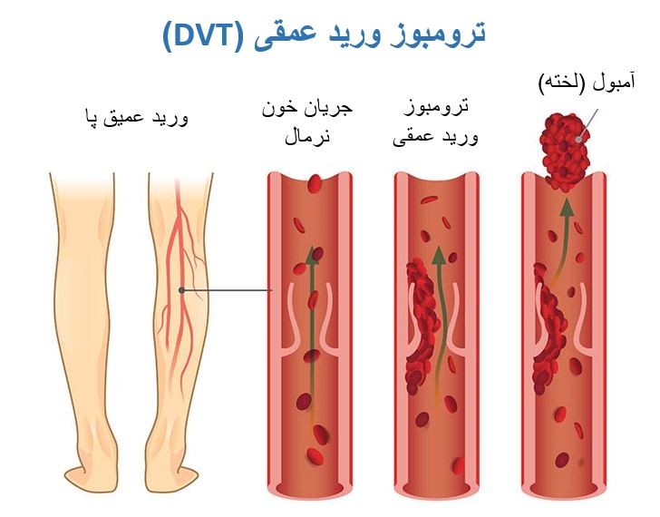 تفاوت آمبولی و ترمبوز ورید عمقی