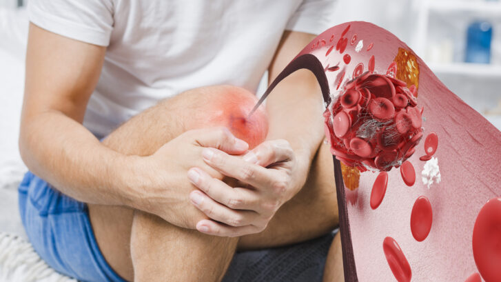 علائم بروز عارضه DVT