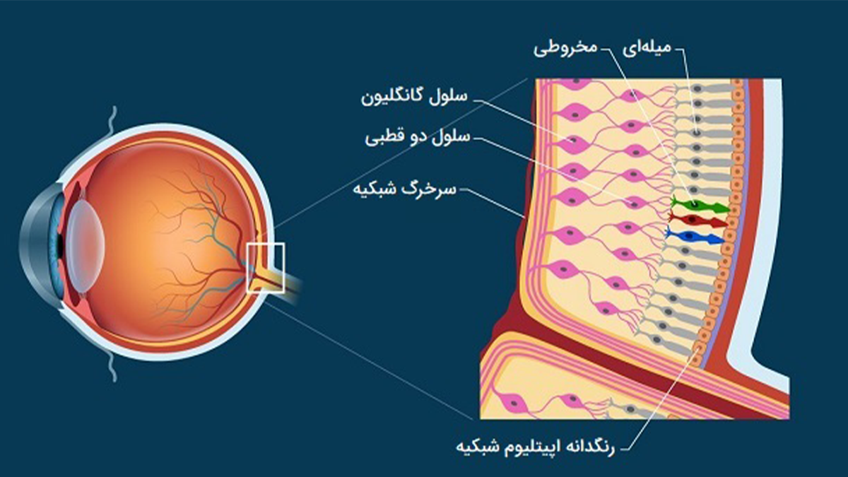 درصد موفقیت عمل شبکیه چشم