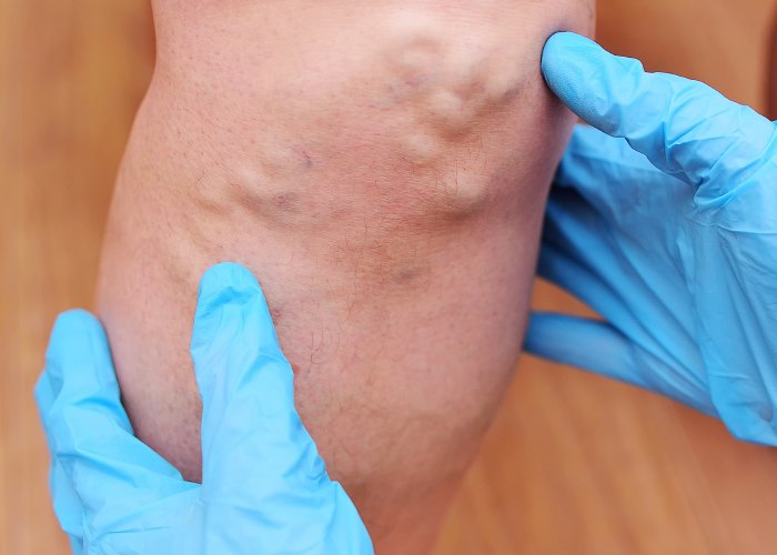 دستگاه پمپ dvt