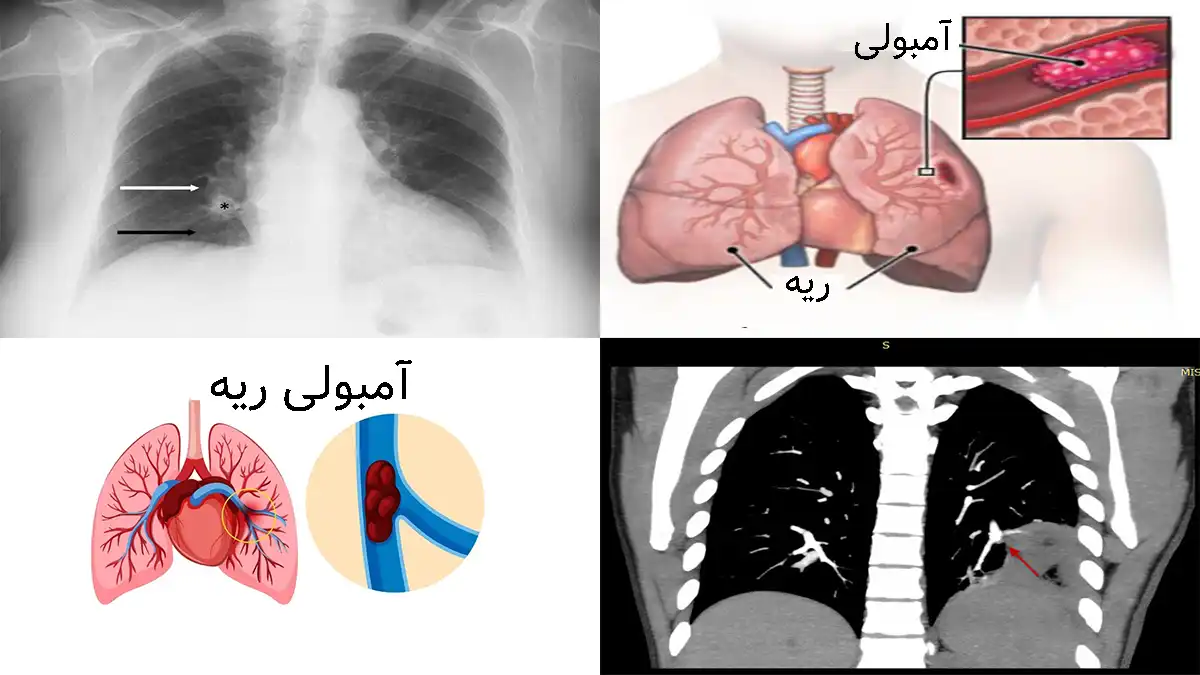 عکس آمبولی ریه