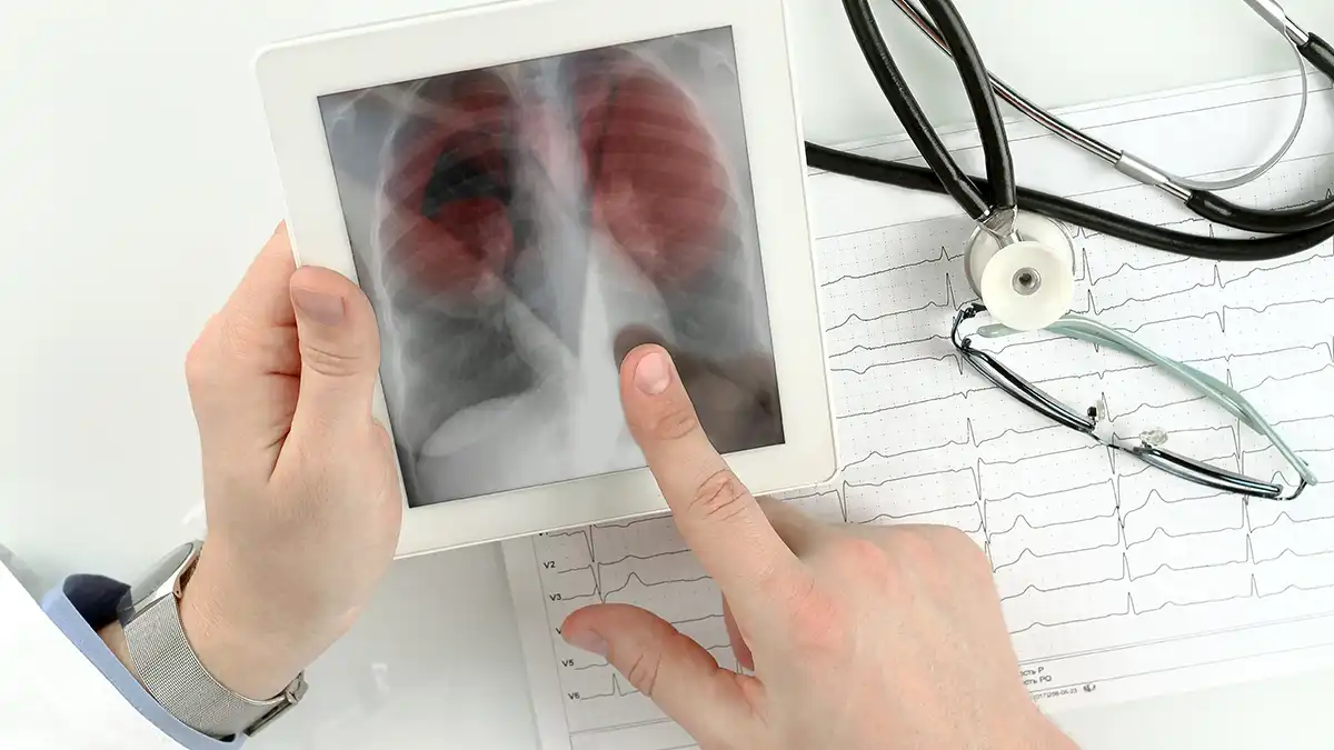 آیا لخته شدن خون در پا منجر به آمبولی ریه میشود