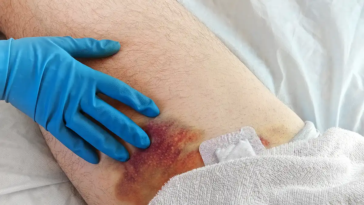 علائم لخته شدن خون