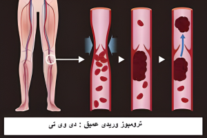 دی وی تی چیست