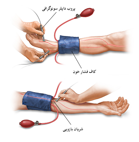 LOP & AOP: چگونه فشار انسداد اندام را محاسبه کنیم