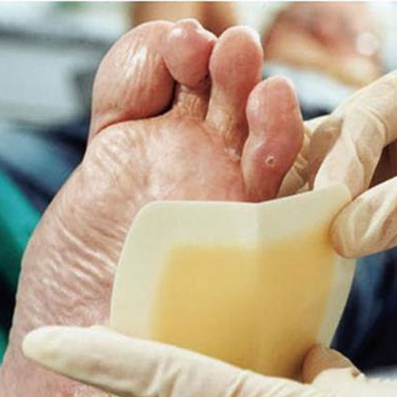  پانسمان‌های هیدروکلوئیدی (Hydrocolloid Dressings)