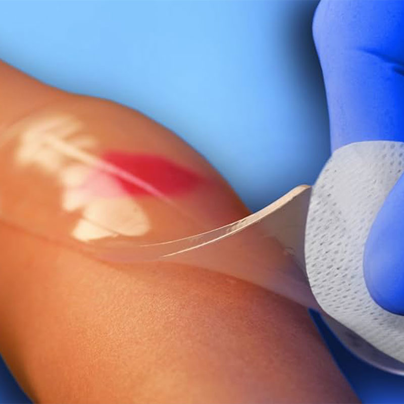 2. پانسمان‌های هیدروژلی (Hydrogel Dressings)