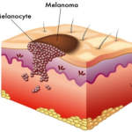 زخم بستر درجه ۳