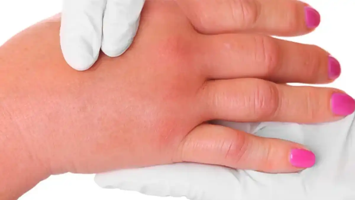 ورم یک دست در بارداری