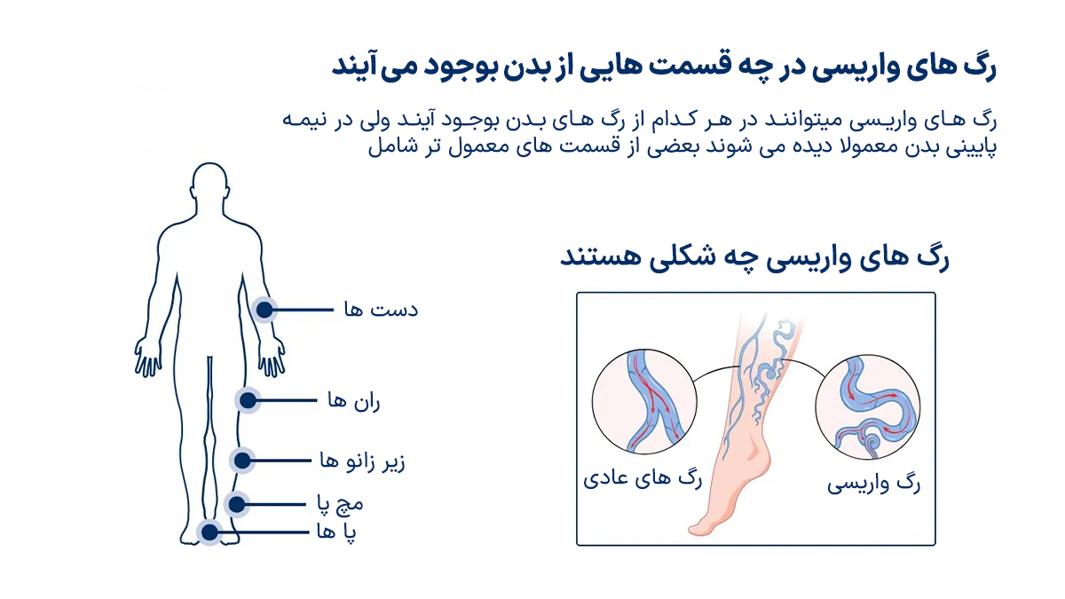 جلوگیری از پیشرفت واریس
