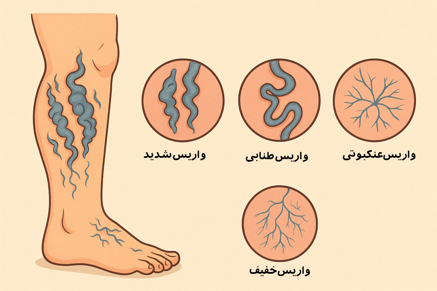 واریس چند نوع است