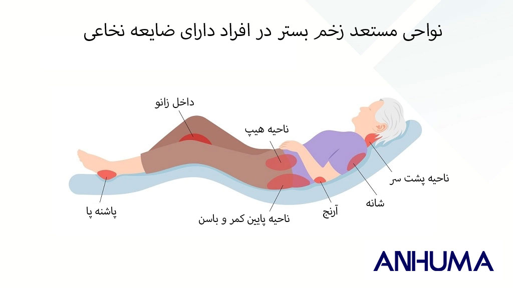 پیشگیری از زخم بستر در بیماران قطع نخاع