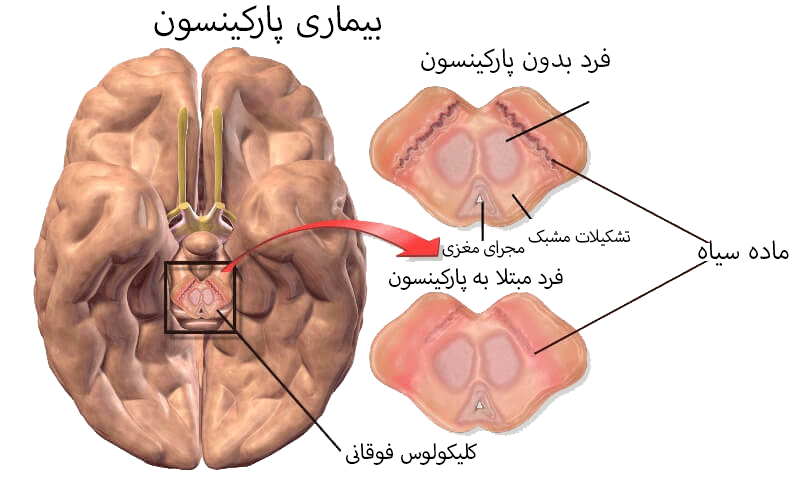 زخم بستر در بیماران پارکینسون