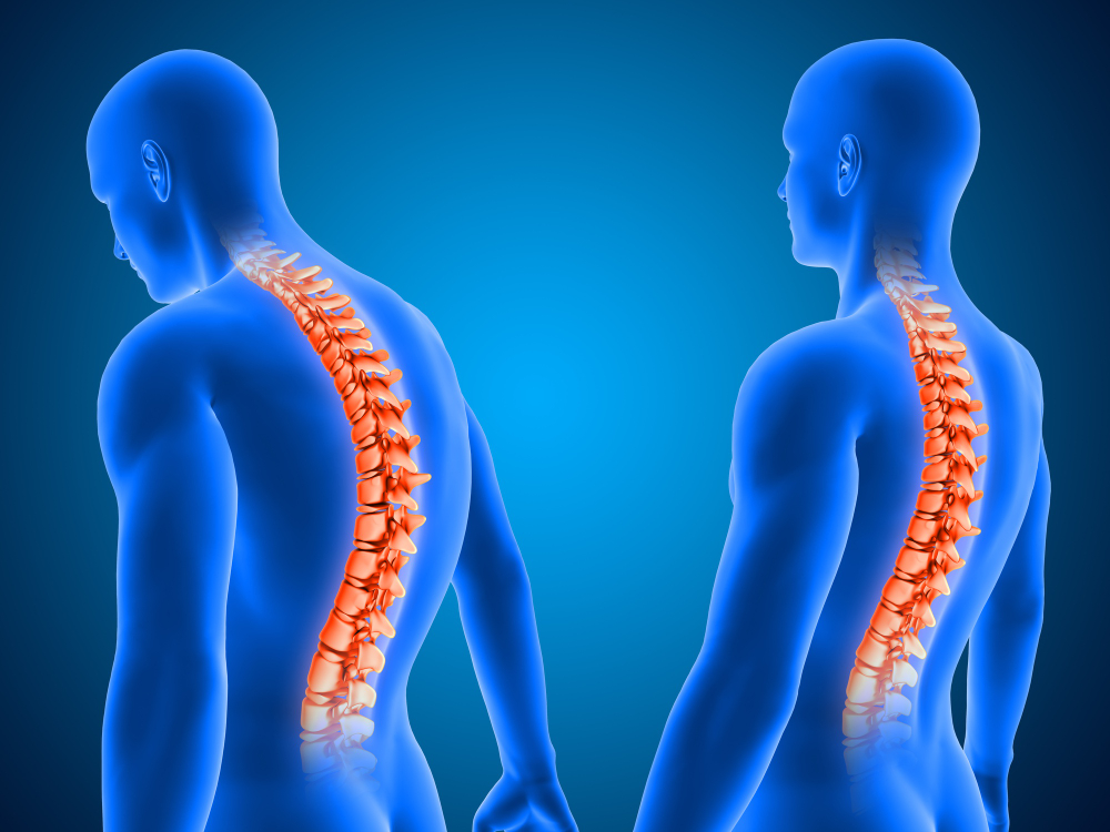 آسیب ناقص نخاعی و طبقه‌بندی آن