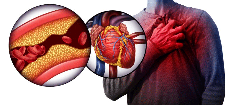 زخم بستر در بیماران مبتلا به نارسایی قلبی چیست و چرا اهمیت دارد؟
