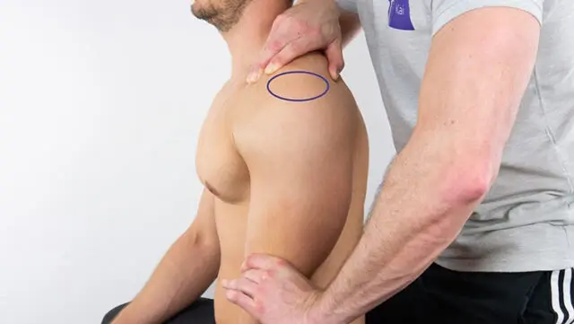 تست سولوکوس (Sulcus Sign)