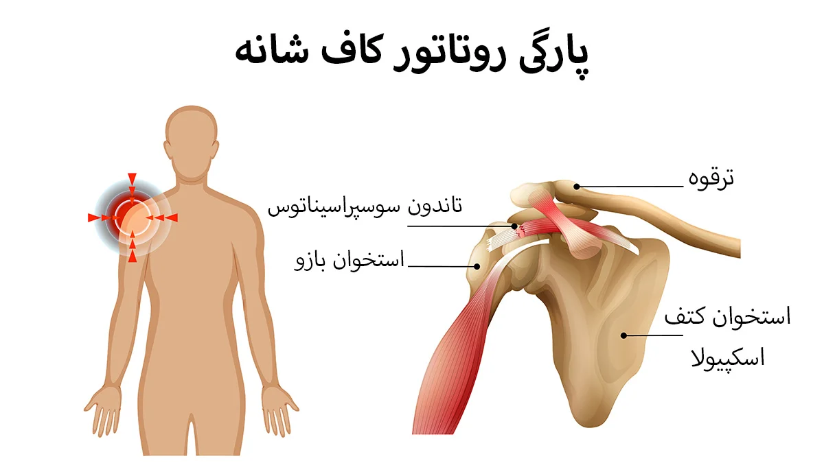 پارگی روتاتور کاف در شانه یعنی چه؟