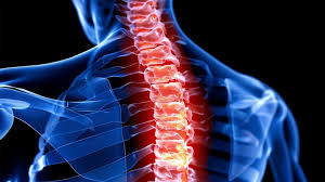 Transverse Myelitis