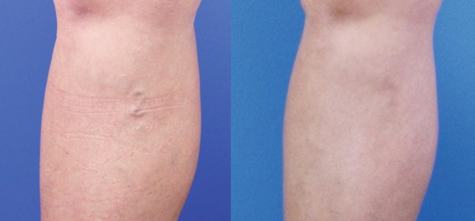 عکس واریس خفیف پا