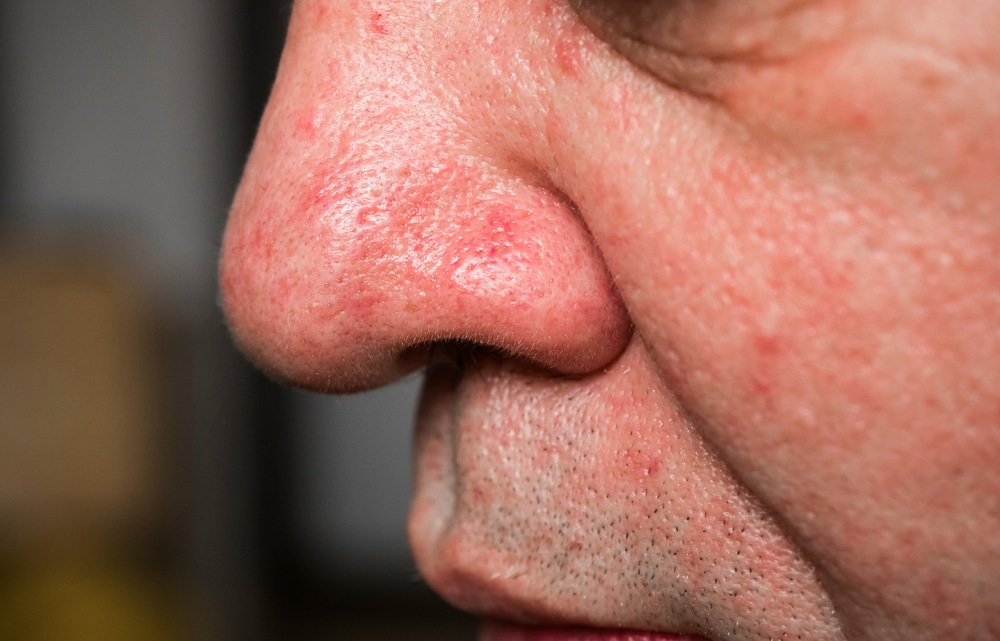 عکس واریس صورت
