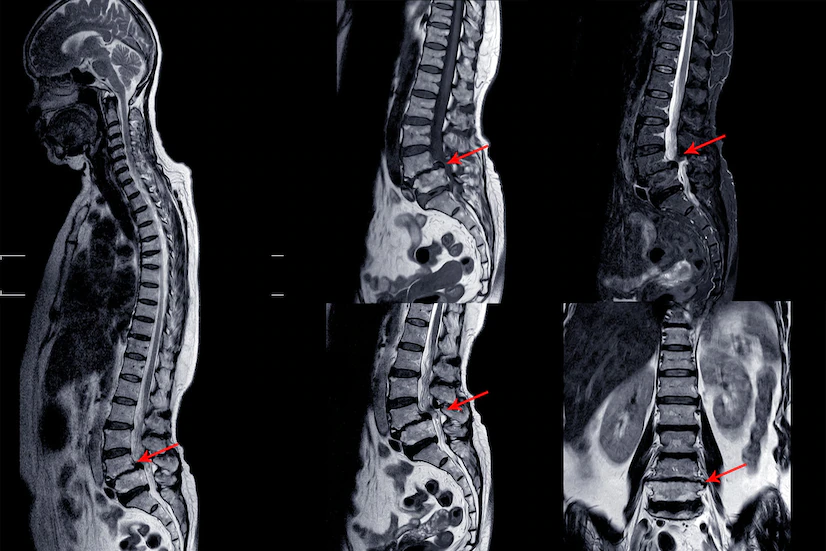 لامینکتومی (Laminectomy)