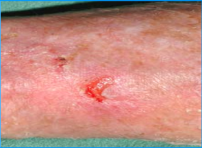 عکس انواع زخم های پوستی