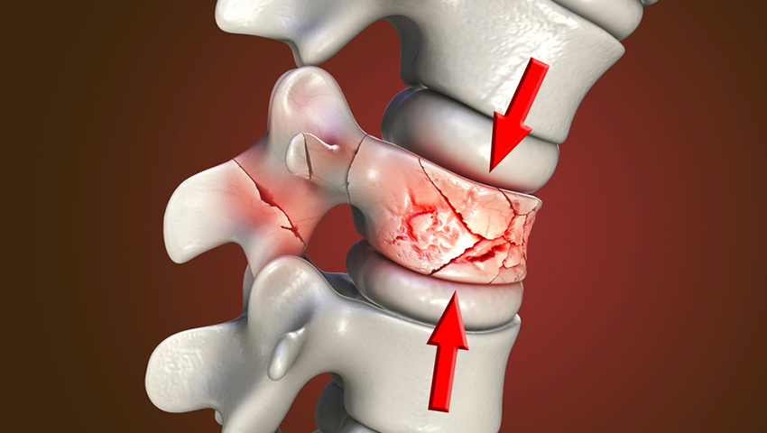 ترمیم شکستگی‌های مهره‌ای (Spinal Fracture Repair)