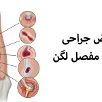 عوارض جراحی تعویض مفصل لگن