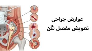 عوارض جراحی تعویض مفصل لگن