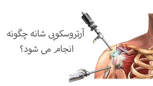 آرتروسکوپی شانه چگونه انجام می شود