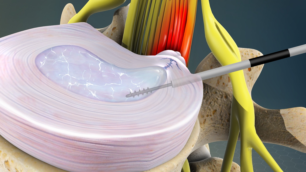 دیسککتومی (Discectomy)