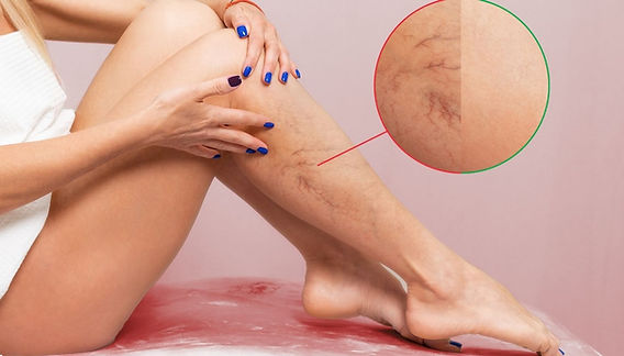 علائم رایج واریس پا در دوران بارداری