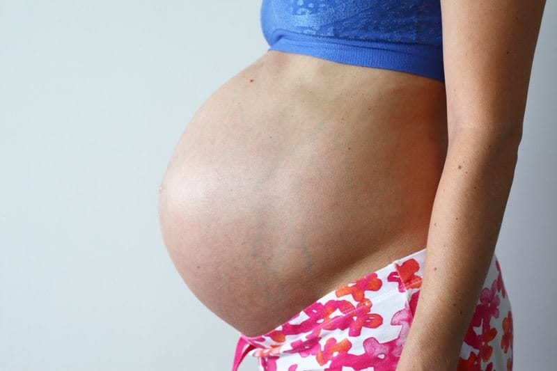 عکس واریس پا در بارداری