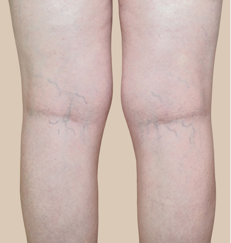 عکس واریس خفیف پا