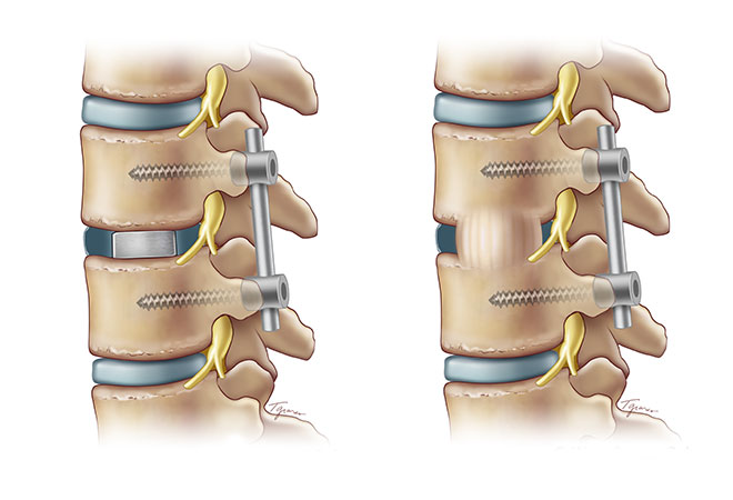 فیوژن ستون فقرات (Spinal Fusion)