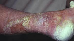 عکس انواع زخم های پوستی