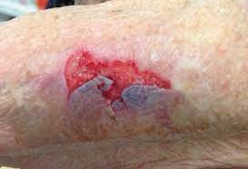 عکس انواع زخم های پوستی