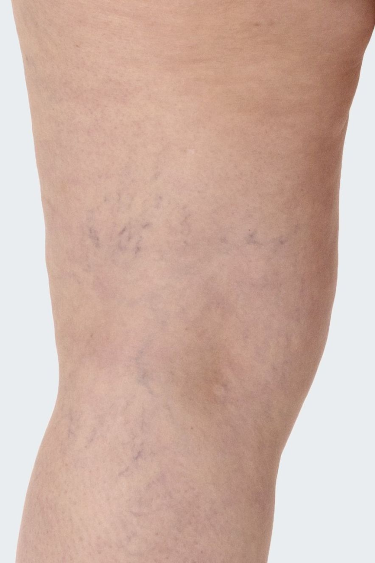 عکس واریس خفیف پا