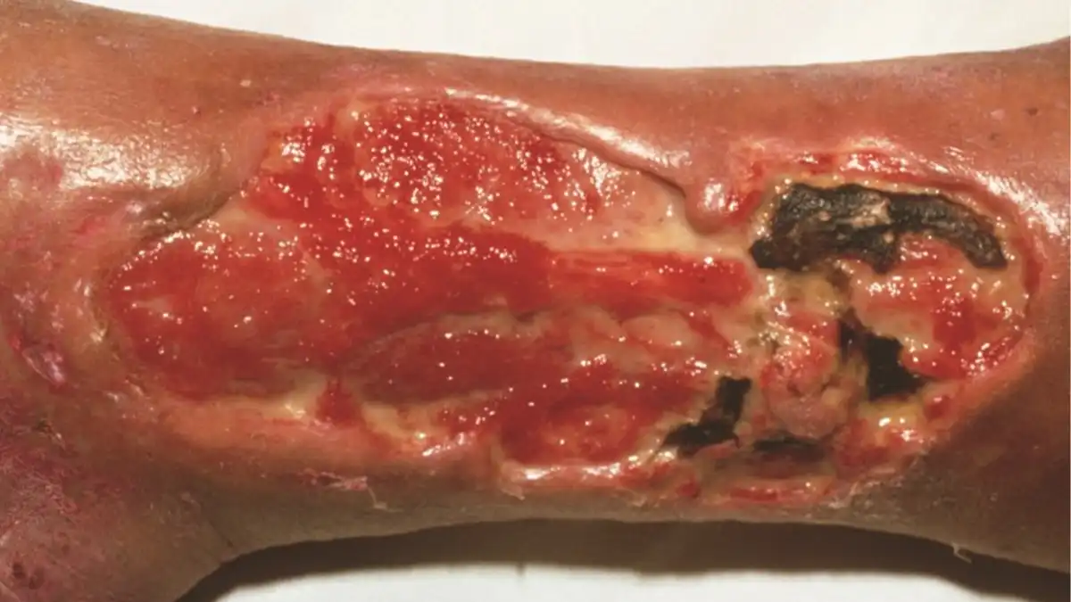 عکس عفونت زخم