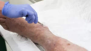 12 روش درمان زخم پای دیابتی در منزل روش های درمان زخم پای دیابتی در منزل