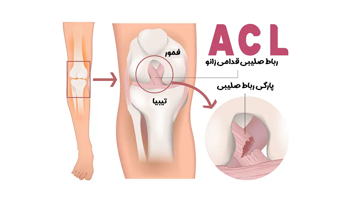 پارگی رباط صلیبی (ACL) چیست؟