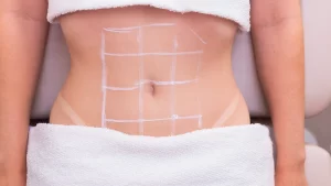 آمبولی بعد از جراحی ابدومینوپلاستی